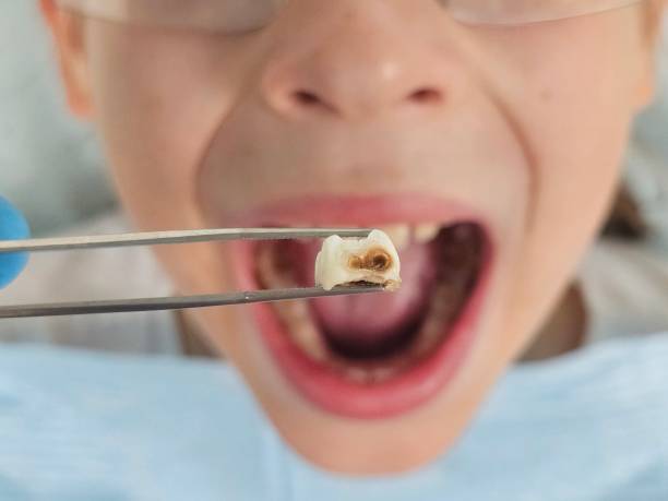 Best Urgent Care for Lost Fillings or Crowns in St Marys, GA